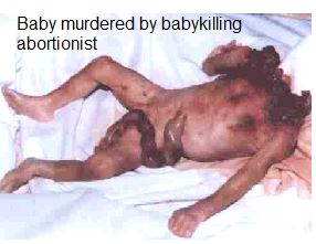 Baby killed by abortion